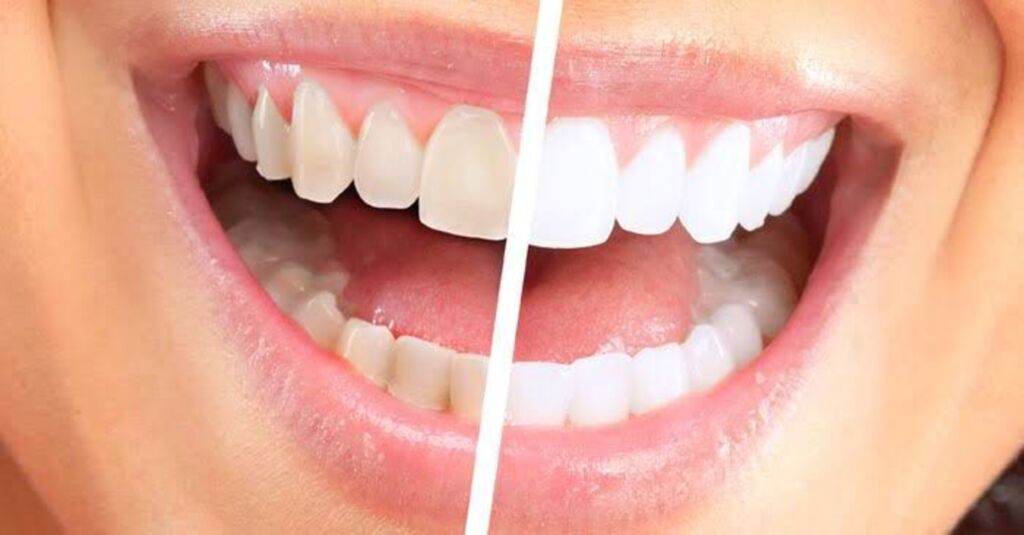 Clareamento dental caseiro é seguro? Saiba os riscos e benefícios