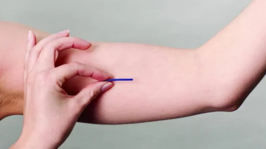 Imagem  Piauí Hoje - Implante contraceptivo com eficácia de 99,95% será oferecido pelo SUS