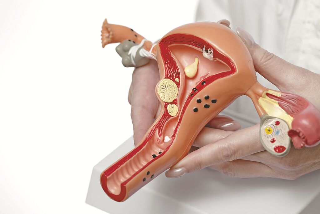 SUS incorpora novos tratamentos hormonais para endometriose