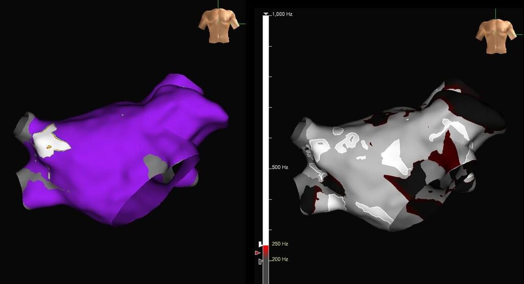 HOSPITAL DOM JOAQUIM É PIONEIRO EM PROCEDIMENTO COM MAPEAMENTO ELETROANATÔMICO TRIDIMENSIONAL (3D) NA REGIÃO DA AMESC
