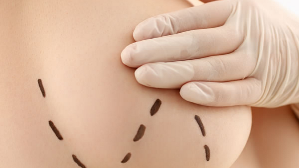 Brasil registra primeiro caso de câncer de mama associado a implante de silicone
