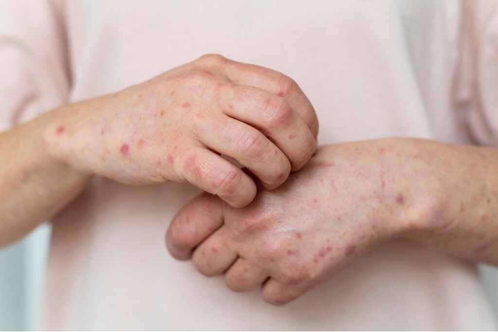 Dermatite atópica: 10 fatores que podem agravar a doença