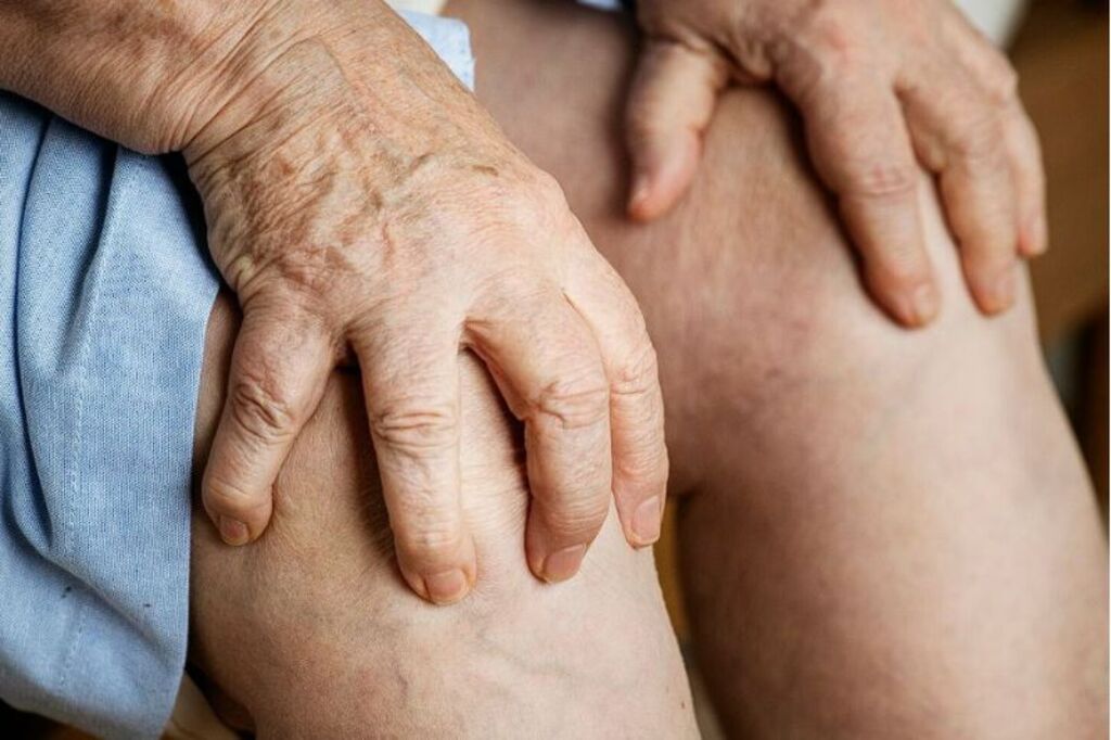 Varizes: causas, prevenção e opções de tratamento