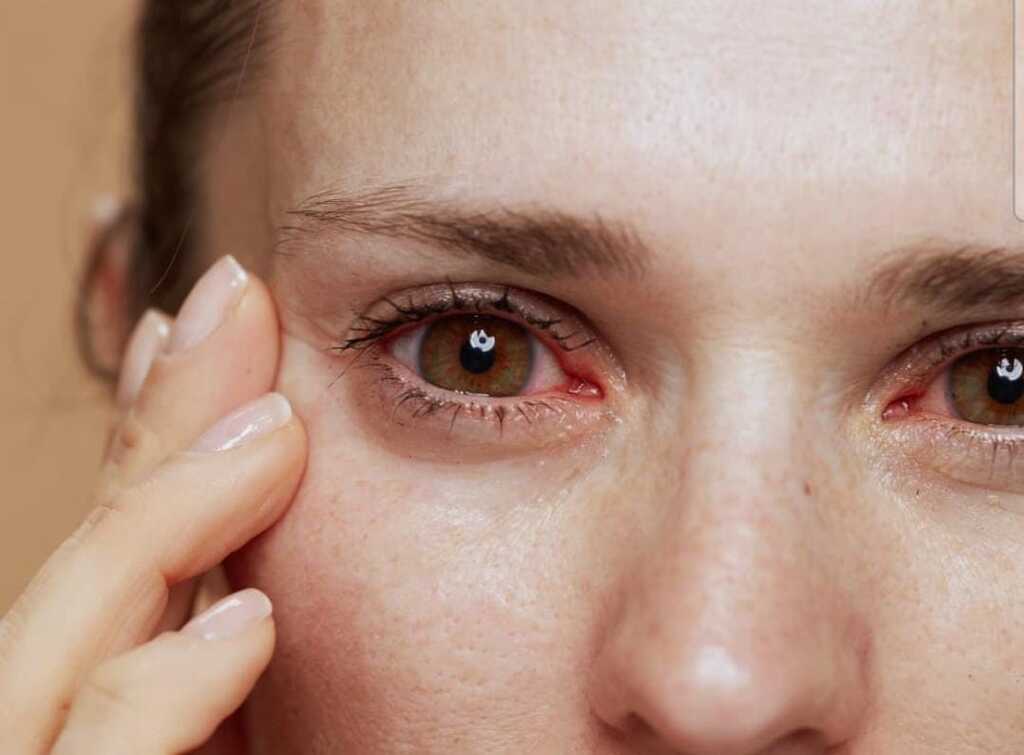 SOCIEDADE CATARINENSE DE OFTALMOLOGIA ALERTA PARA ALERGIAS OCULARES NA PRIMAVERA