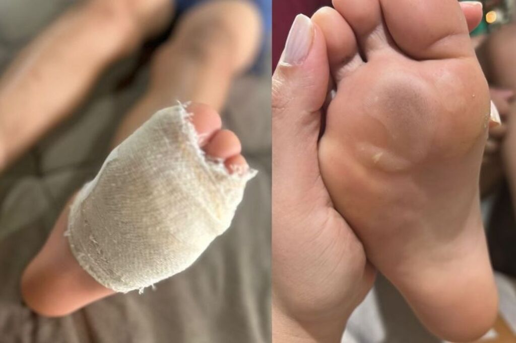 Foto: Arquivo pessoal/ - Criança sofre queimaduras nos pés durante aula em escola de SC