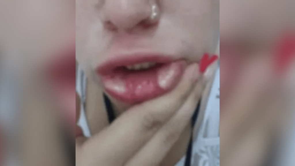 PMMA nos lábios termina em necrose e expõe riscos de procedimento estético em SC
