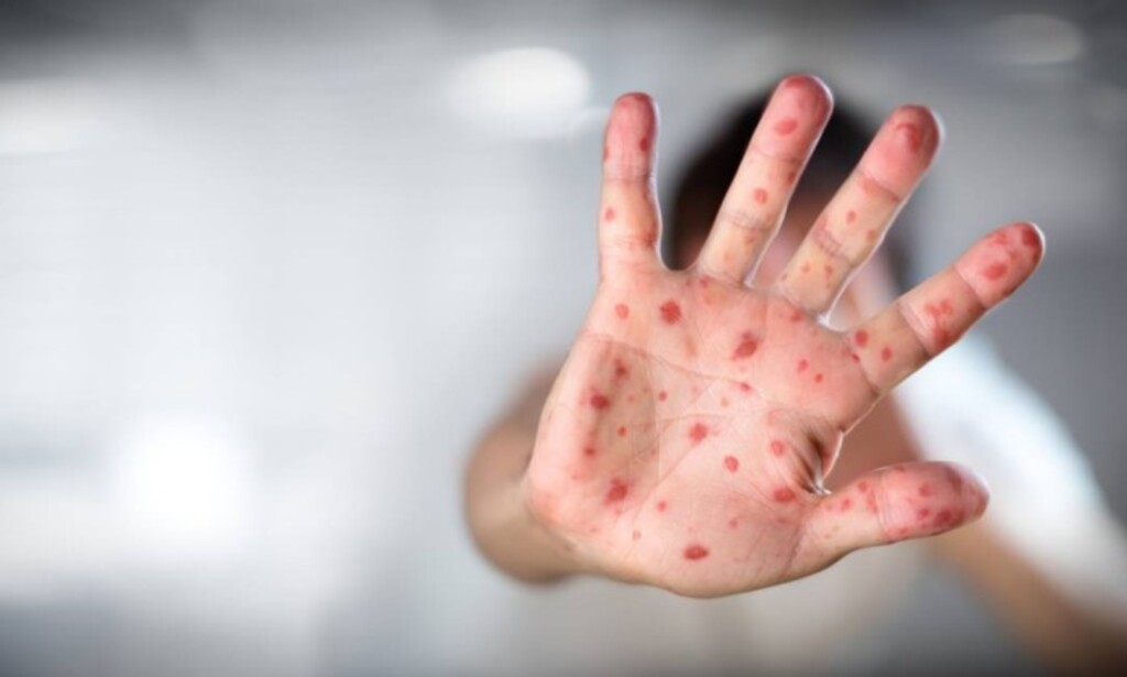 Saúde alerta para vacinação contra o Sarampo