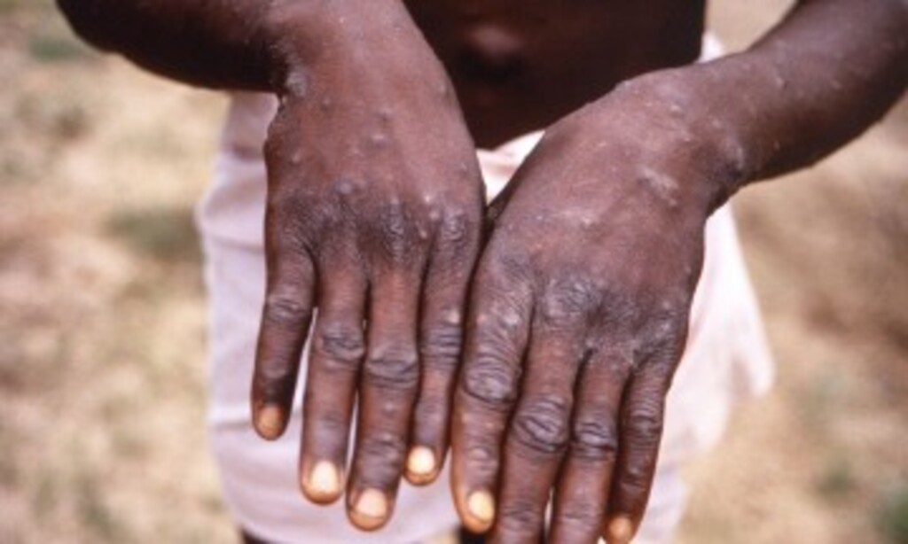 Rio Grande do Sul confirma transmissão comunitária da monkeypox