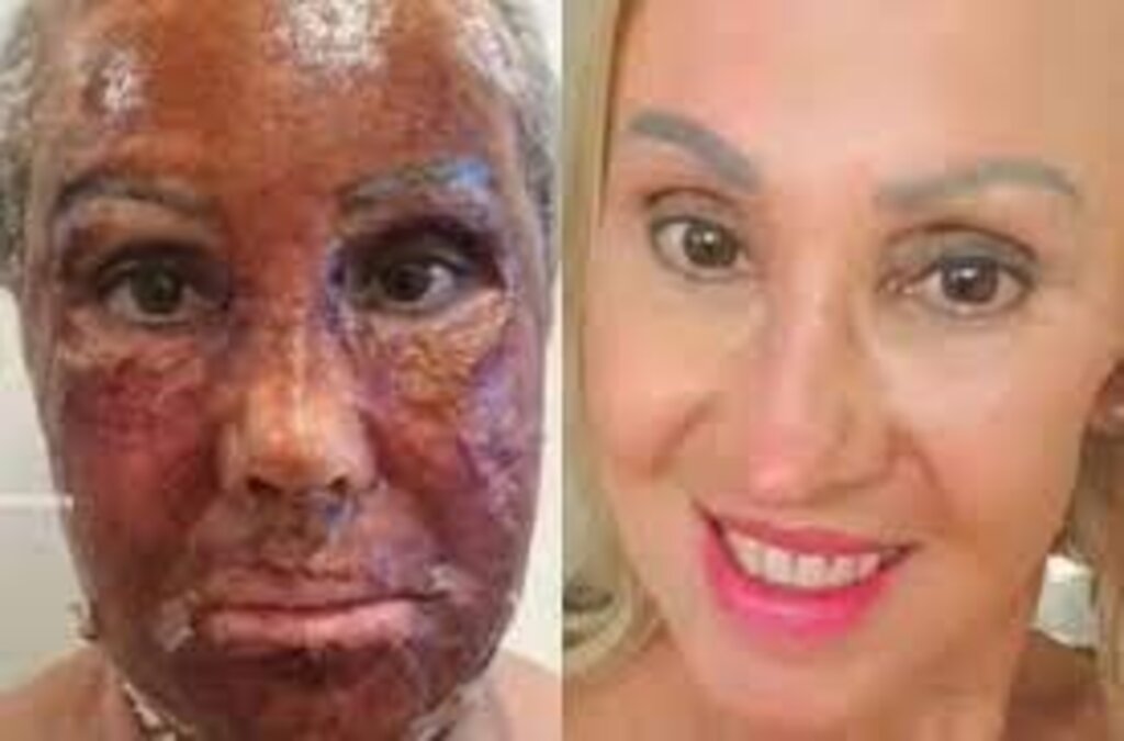 Mulher 'troca de rosto' após procedimento estético e mudança viraliza na web; vídeo