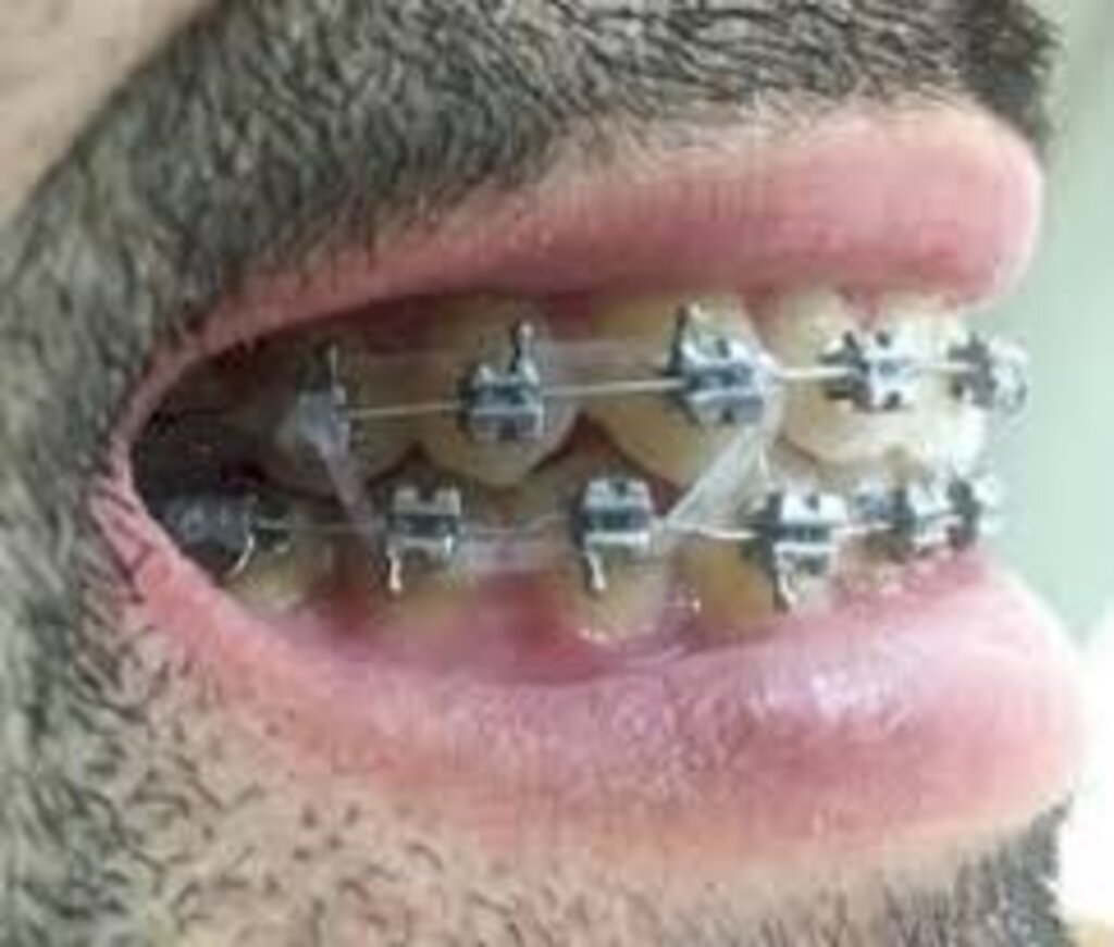 Dor de dente após a manutenção do aparelho ortodôntico é normal?