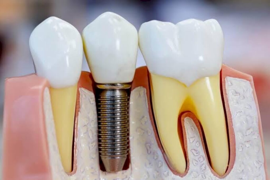 O organismo pode rejeitar um implante dentário?
