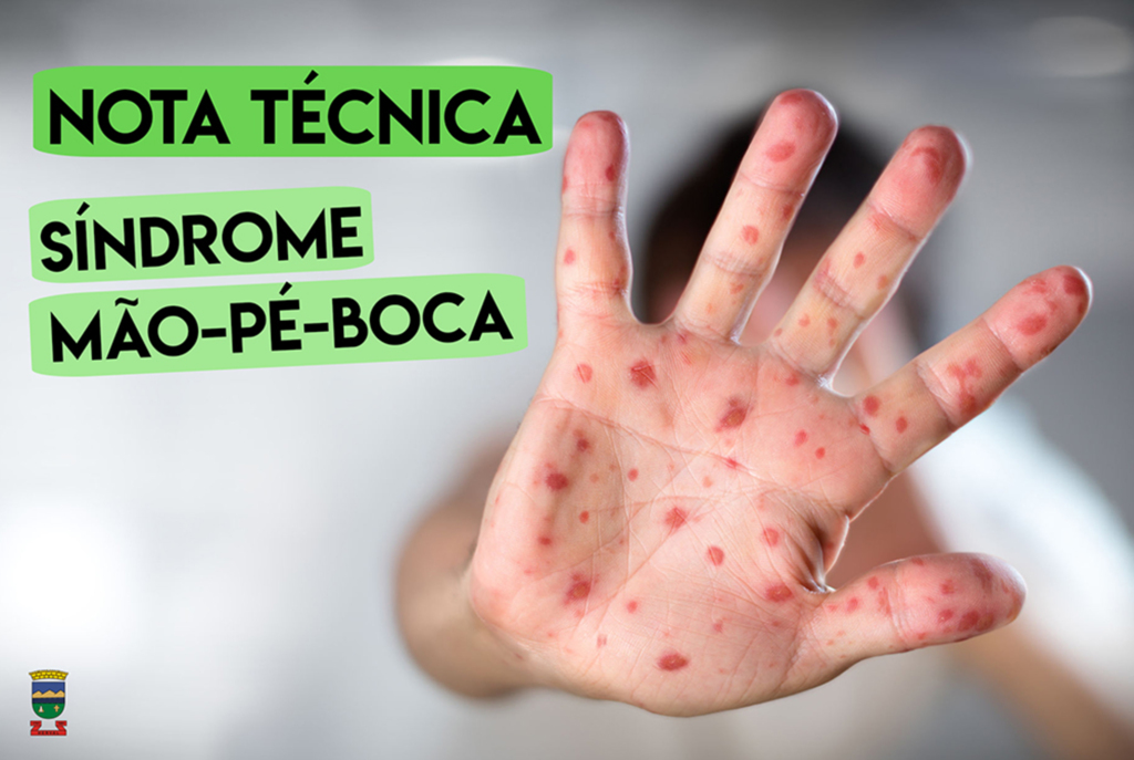 Herval: Secretarias de Educação e de Saúde alertam sobre o surto de mão-pé-boca