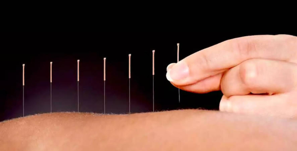 Serviços de Acupuntura e Auriculoterapia em Vargem