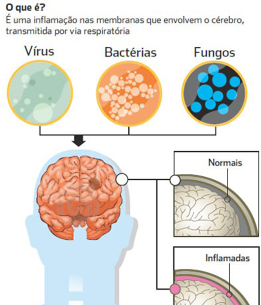 O que é meningite?