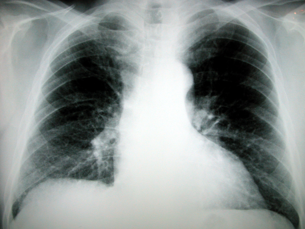 Número de casos de tuberculose em Pelotas aumentou 20% de 2014 para 2015