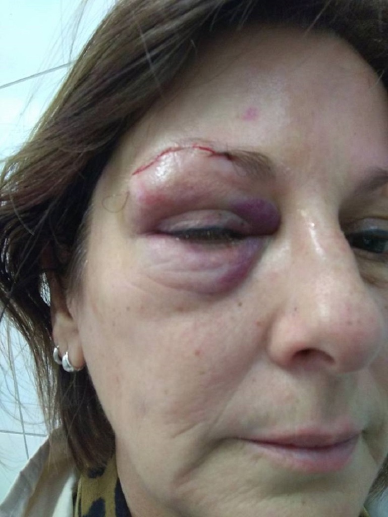 Divulgação - Professora Marcia precisou de sutura na altura do supercílio após ser agredida por aluno