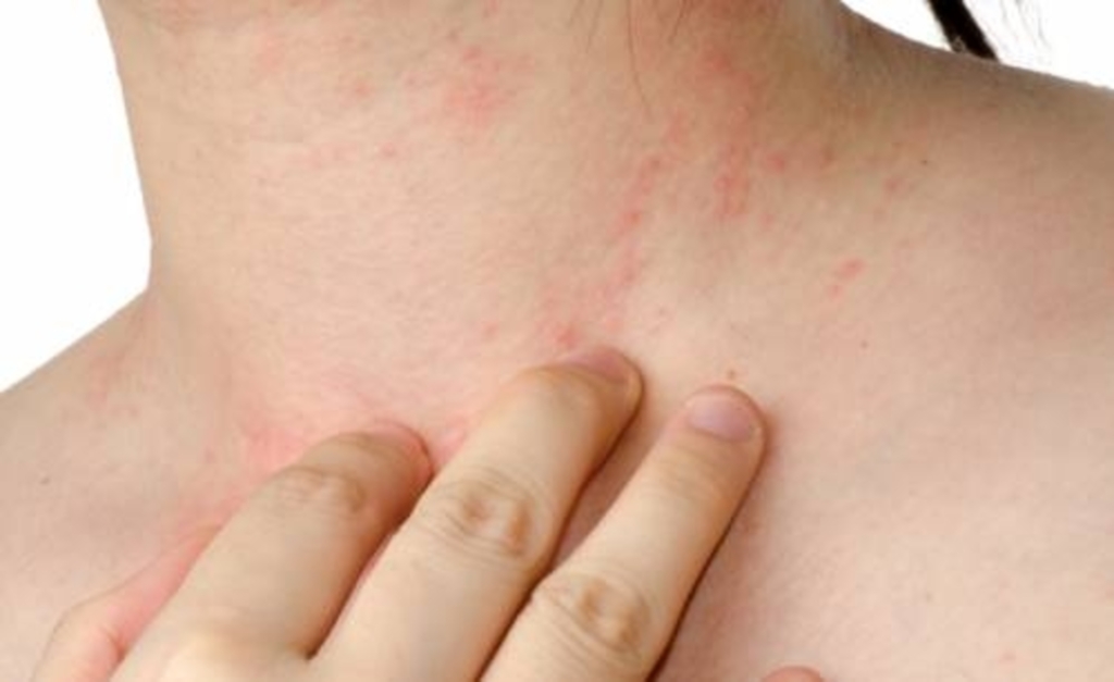 Posto de Saúde, de Pinhalzinho, atenderá neste sábado (13) pessoas com sintomas de dengue