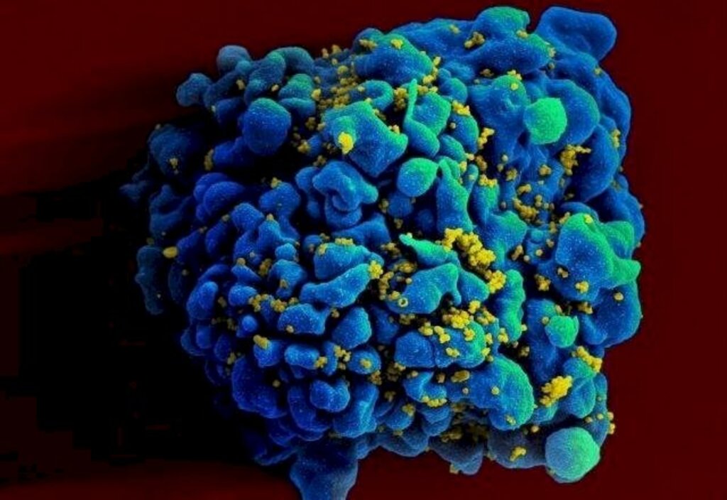 Mulher é curada de HIV após tratamento com células-tronco, dizem pesquisadores