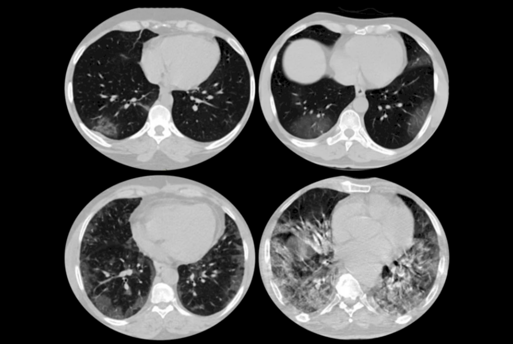 Análise online de tomografias auxilia no diagnóstico de Covid-19