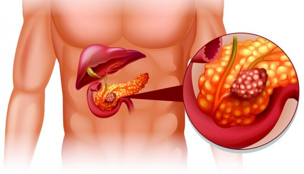 Câncer de pâncreas e fígado estão em estimativa para os próximos anos