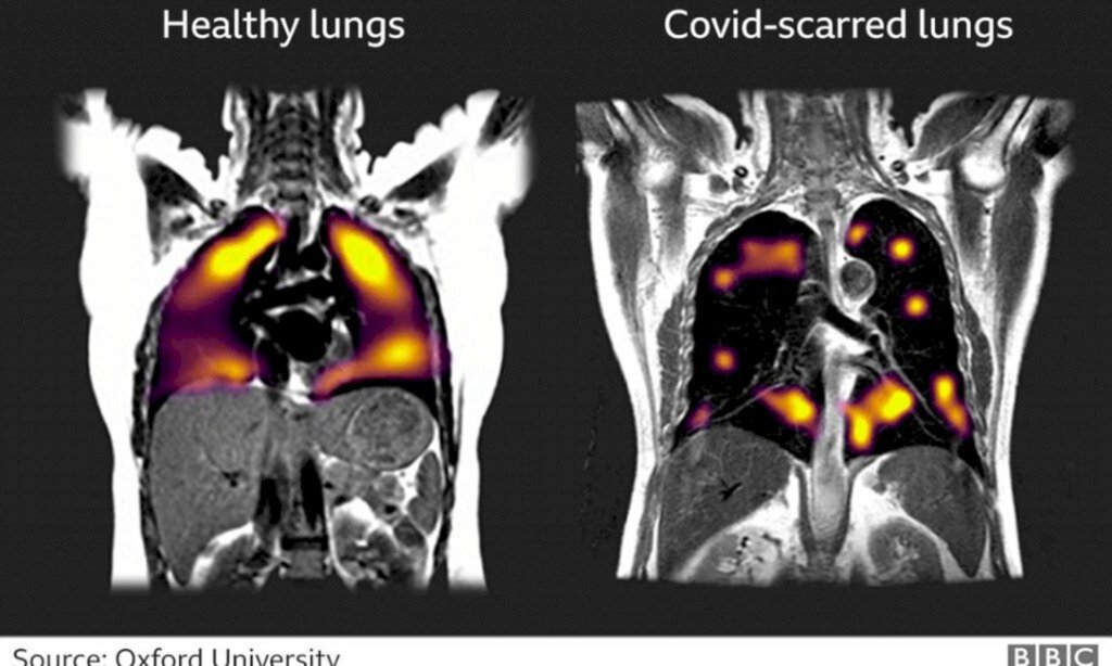 Exame pioneiro mostra danos em pulmões três meses após a infecção