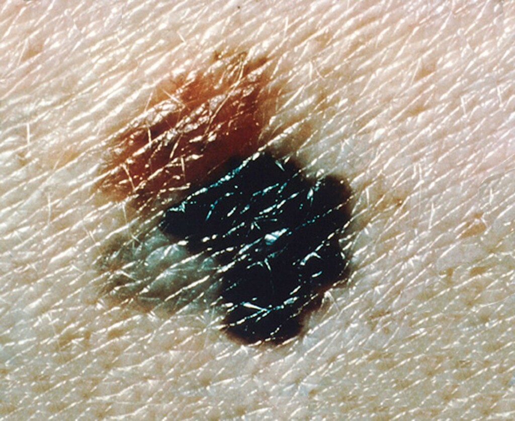  - Taxa de mortalidade por melanoma aumentou em homens ? Foto: https://commons.wikimedia.org/w/index.php?curid=24053016