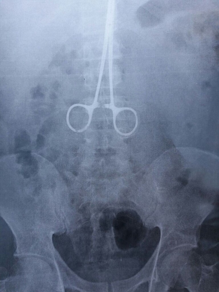  - Radiografia feita em Juiz de Fora mostra que pinça estava alojada no abdômen de operário com a ponta direcionada para o coração (Foto: Ivanildo de Oliveira/Arquivo Pessoal)