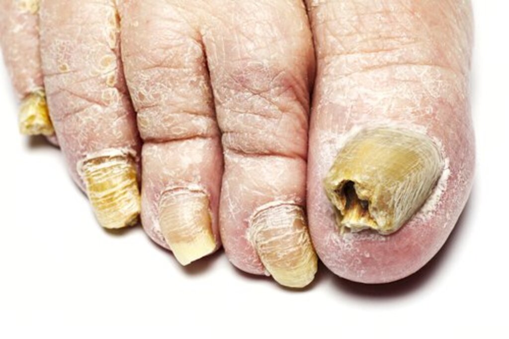 Por Ma. Vanessa dos Santos - Os fungos podem atingir as unhas e alimentar-se da queratina presente nelas