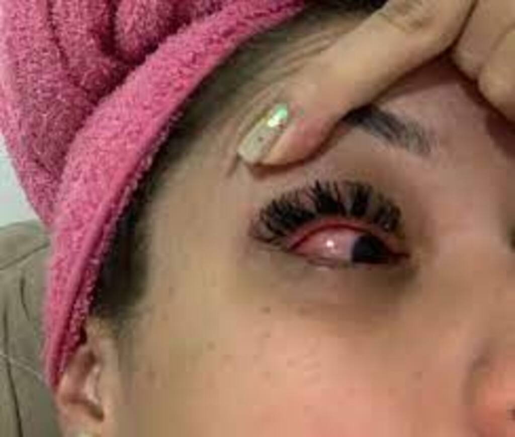 Foliões têm problemas nos olhos após uso de produto capilar em prévias de carnaval