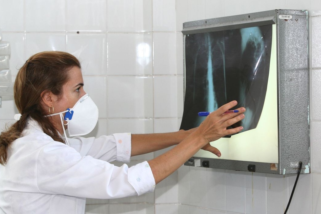 Brasil registra 78 mil novos casos de tuberculose em 2022