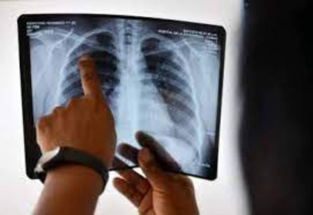 Quase 2 mil casos de tuberculose foram registrados em SC só em 2022