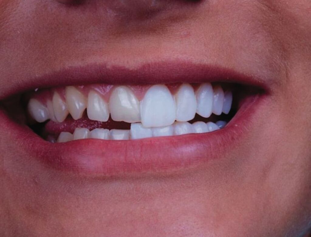 Lente e faceta de porcelana: a diferença está no desgaste do dente