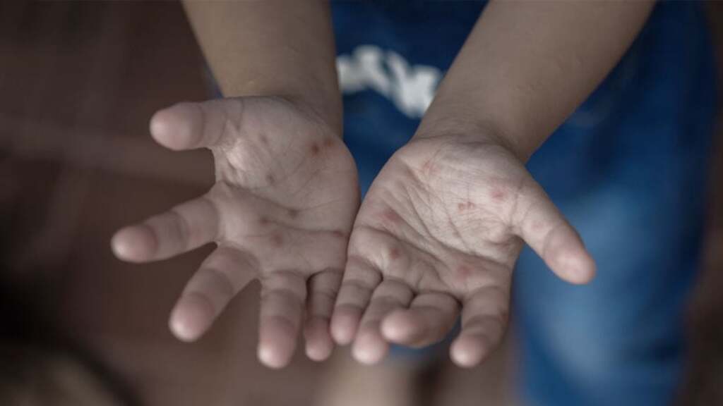 Divulgação - DP - Manchas vermelhas nas mãos e nos pés são comuns
