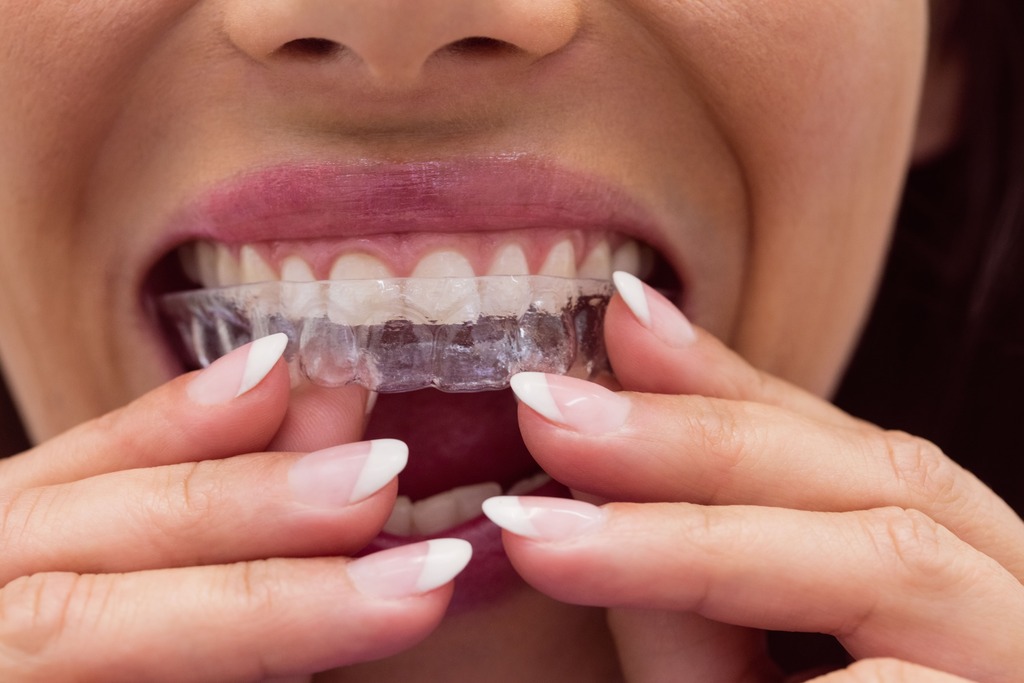 Clareamento dental: um dos procedimentos estéticos mais procurados nos consultórios odontológicos