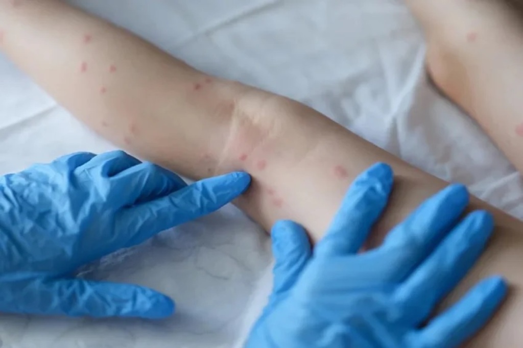 Estado começa planejamento para vacinação contra mpox; primeiras doses chegam nesta quarta-feira