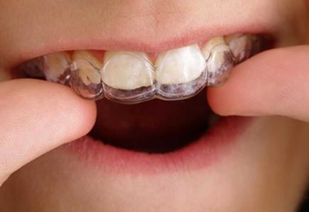 Foto: Divulgação - Os pais não precisam esperar a troca completa dos dentes de seus filhos para cuidar do sorriso deles