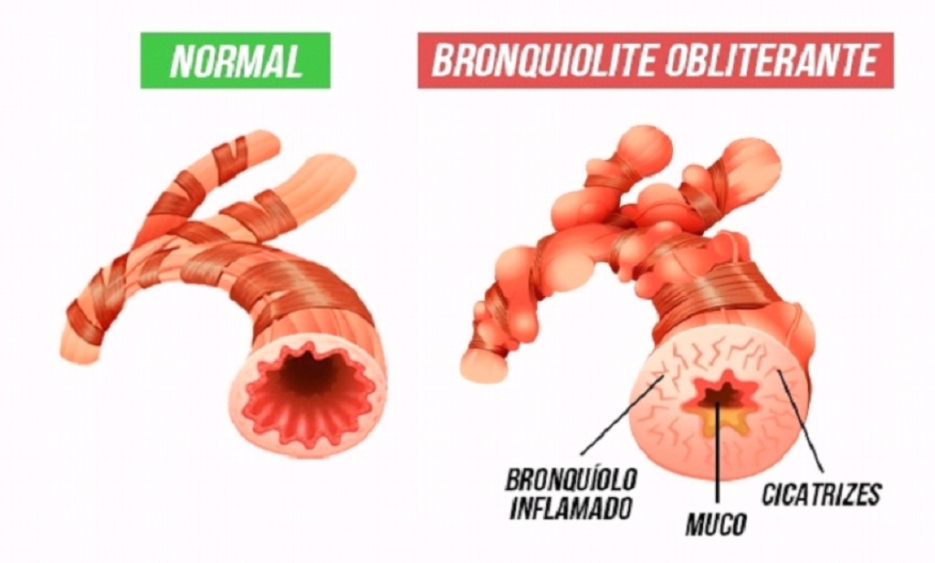 Bronquiolite viral aguda