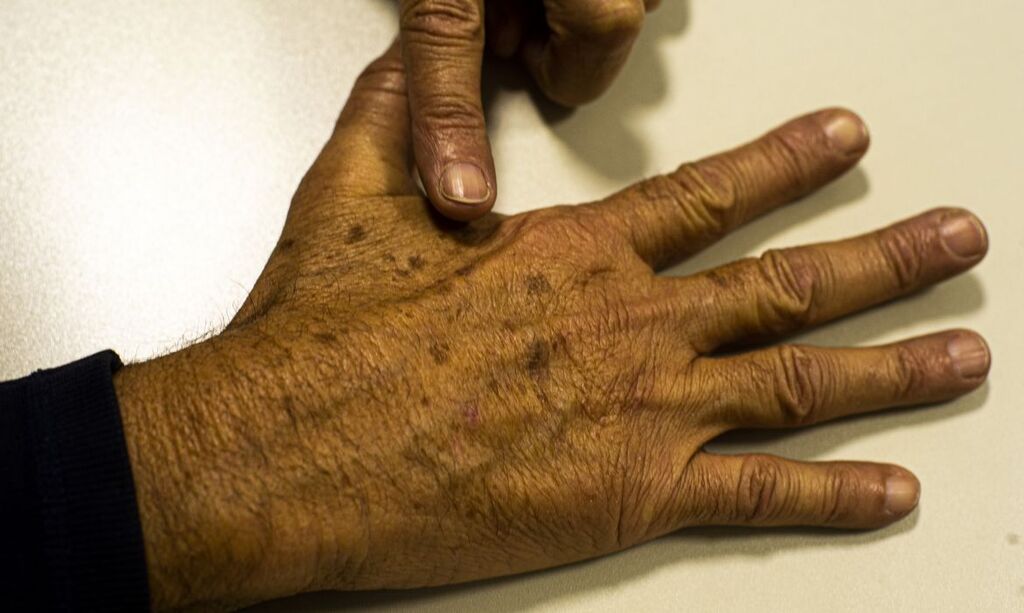 título imagem Tecnologia para tratar câncer de pele é aprovado para uso no SUS