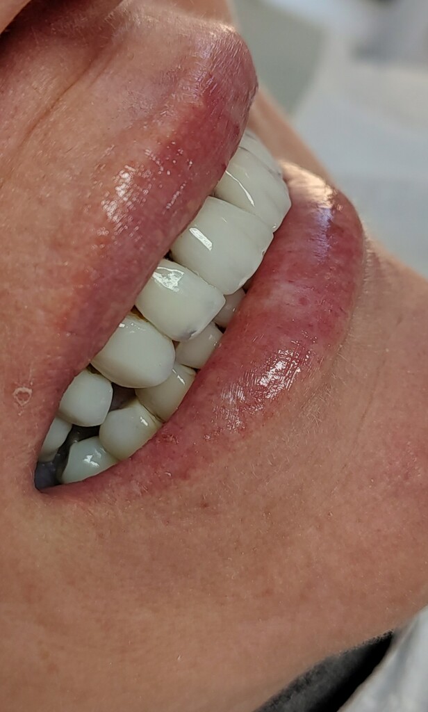 Foto: Divulgação - DP - Agindo como uma capa em toda a arcada dentária ou em apenas alguns dentes, as facetas cobrem manchas, fraturas, além de corrigir formatos irregulares e coloração