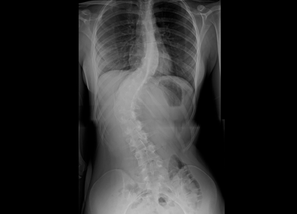 Jovem precisa de R$ 160 mil para cirurgia