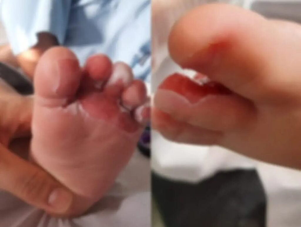 Bebê sofre queimaduras de 2º grau durante banho em creche