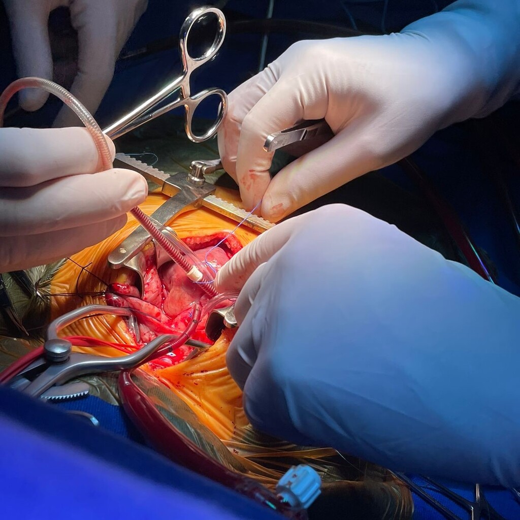 SANTA CATARINA REALIZA CIRURGIA INÉDITA PARA TRATAR CONDIÇÃO CONGÊNITA RARA EM BEBÊ DE TRÊS MESES