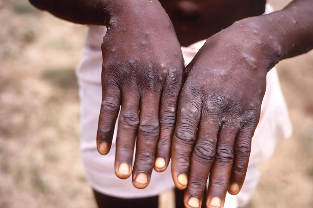 (CDC/Image Point FR/BSIP/Grupo Universal Images via Getty Images) - Mpox: conheça os sintomas e tratamento