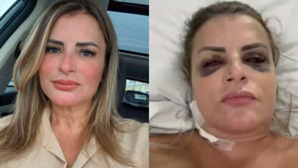 Mulher atropelada e arrastada por 14 metros em SC achou que não sobreviveria: “Ele não parava”